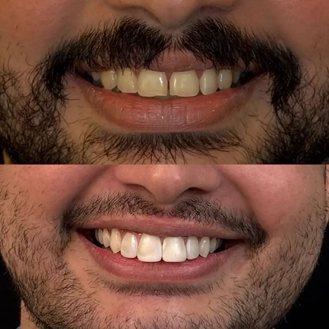 Caso Facetas 001